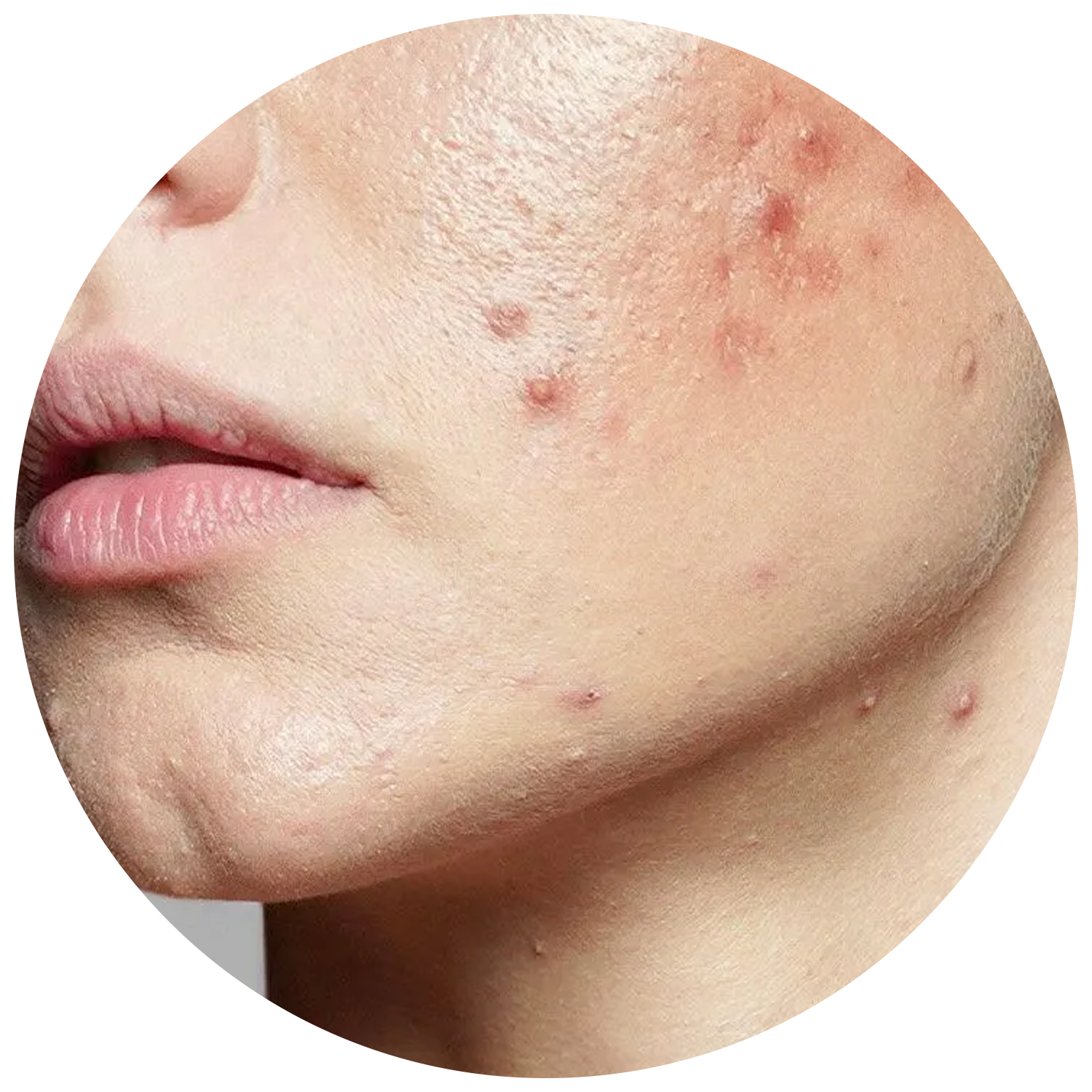 8 مضاد لحب الشباب